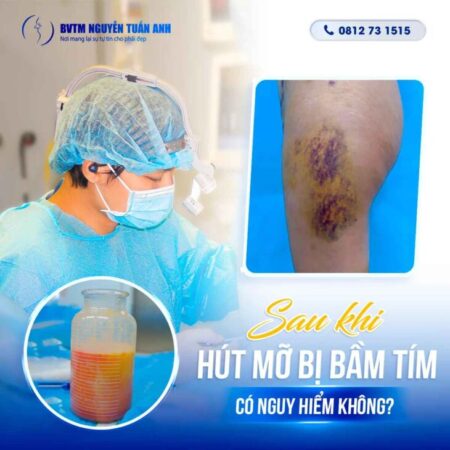 Tại sao sau hút mỡ bị bầm tím? Tại sao sau hút mỡ bị bầm tím?