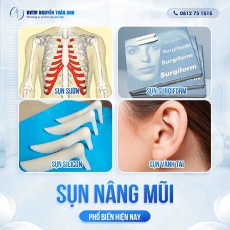 Sụn nâng mũi là gì? Có mấy loại sụn hiện nay? Sụn nâng mũi là gì? Có mấy loại sụn hiện nay?