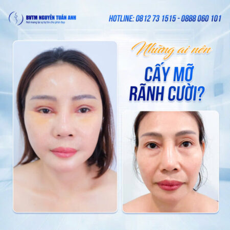 Cấy mỡ rãnh cười Cấy mỡ rãnh cười