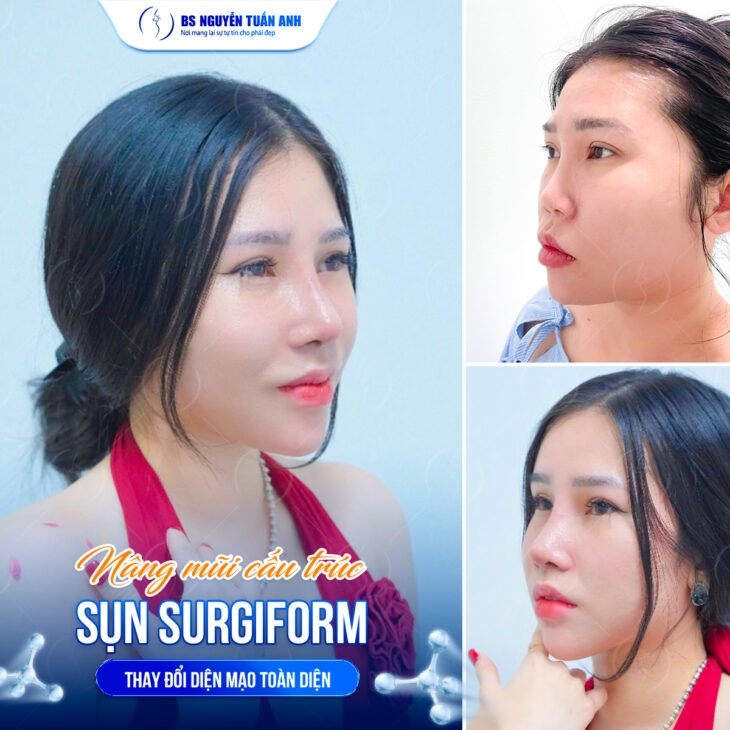 Nâng mũi cấu trúc sụn surgiform