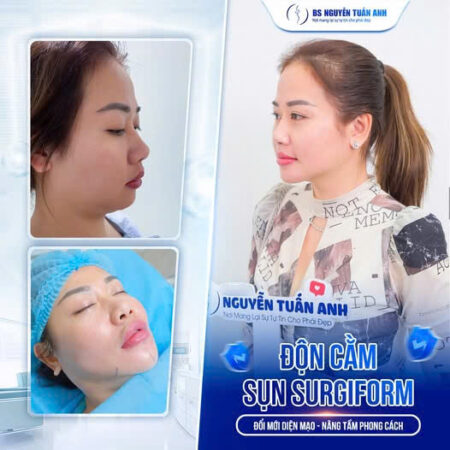 Độn cằm sụn surgiform Độn cằm sụn surgiform