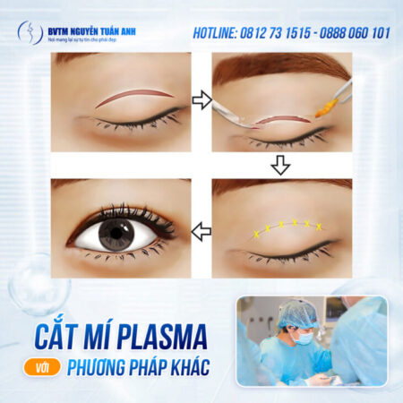 Cắt mí Plasma có thật sự tốt hơn phương pháp khác? Cắt mí Plasma có thật sự tốt hơn phương pháp khác?