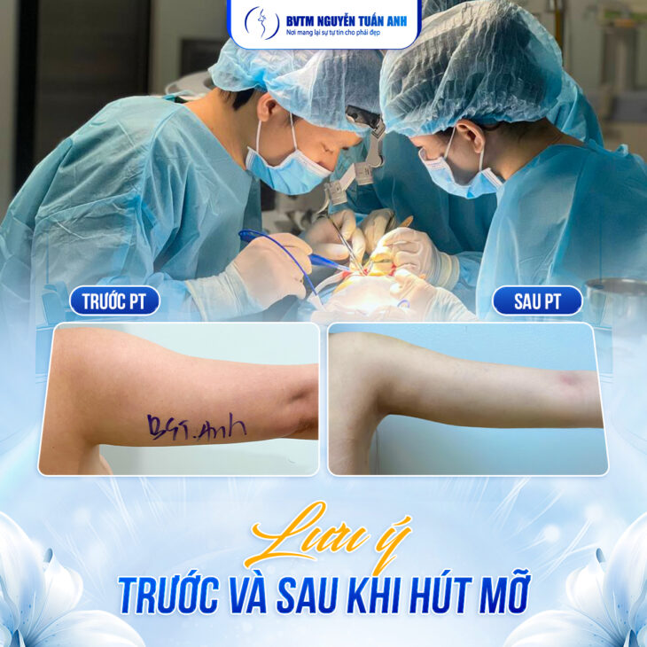 Hút mỡ cánh tay có an toàn và hiệu quả lâu dài không?