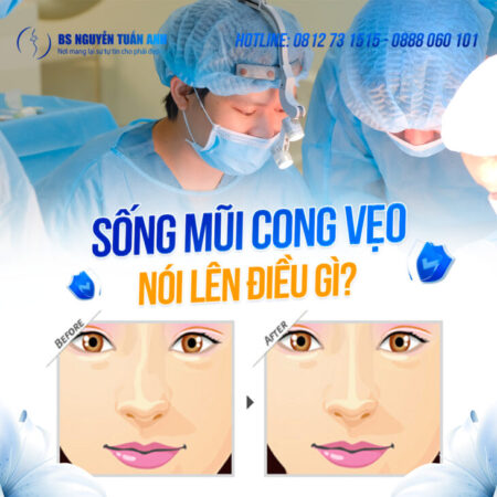 Sống mũi cong vẹo: Tướng tài lộc ? Sống mũi cong vẹo: Tướng tài lộc ?