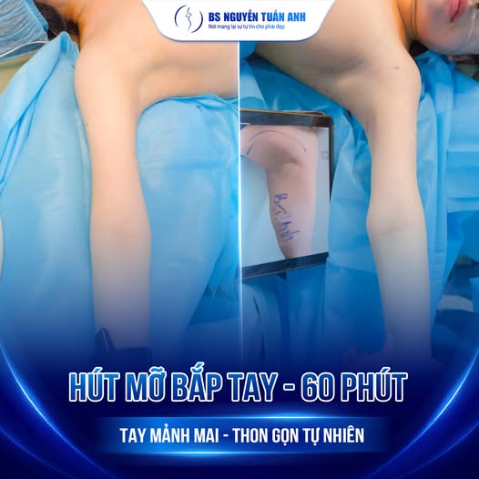 Cánh tay to thô hết lo với giải pháp hút mỡ Lipo