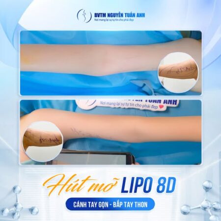 Phẫu thuật hút mỡ sau bao lâu thì sẽ hết sưng và bầm? Phẫu thuật hút mỡ sau bao lâu thì sẽ hết sưng và bầm?