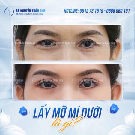 Lấy Mỡ Mí Dưới Có Làm Vùng Mắt Sáng Hơn Không? Lấy Mỡ Mí Dưới Có Làm Vùng Mắt Sáng Hơn Không?