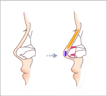 Mũi lộ sóng sau phẫu thì cần sử dụng phương pháp nào?